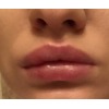  Lip Augmentation 